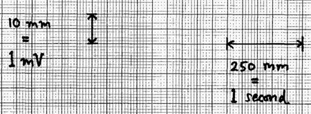 Ecg Chart Paper Sample