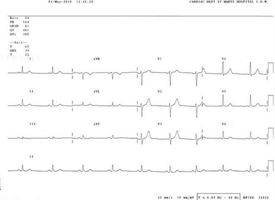 How To Read Cardiogram Chart