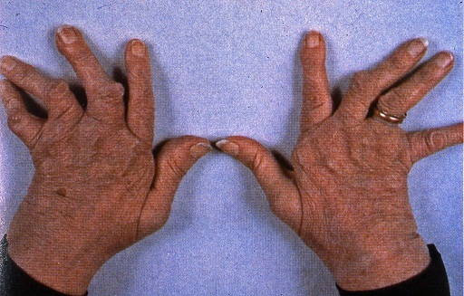 térdváltozások a rheumatoid arthritisben
